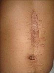 Surgical scar after herniation or rupture (but not the writer's)
